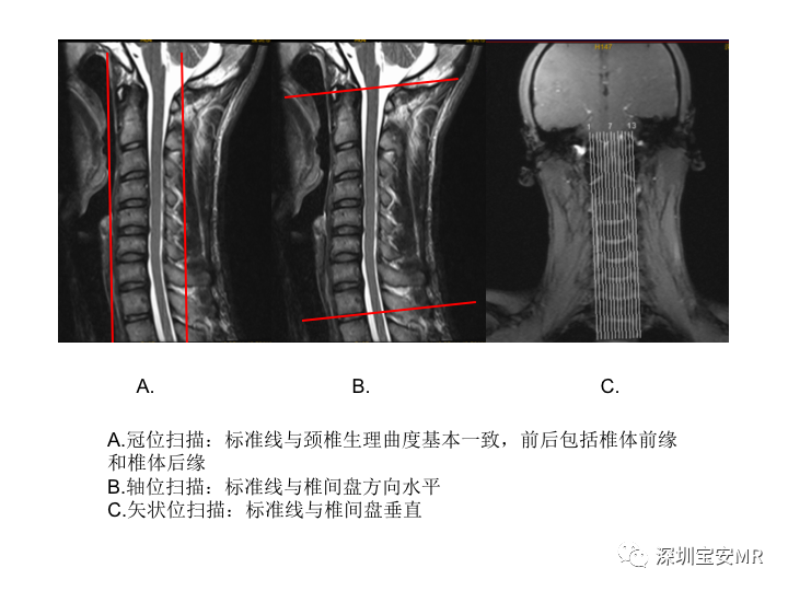 【PPT】臂丛神经MR扫描