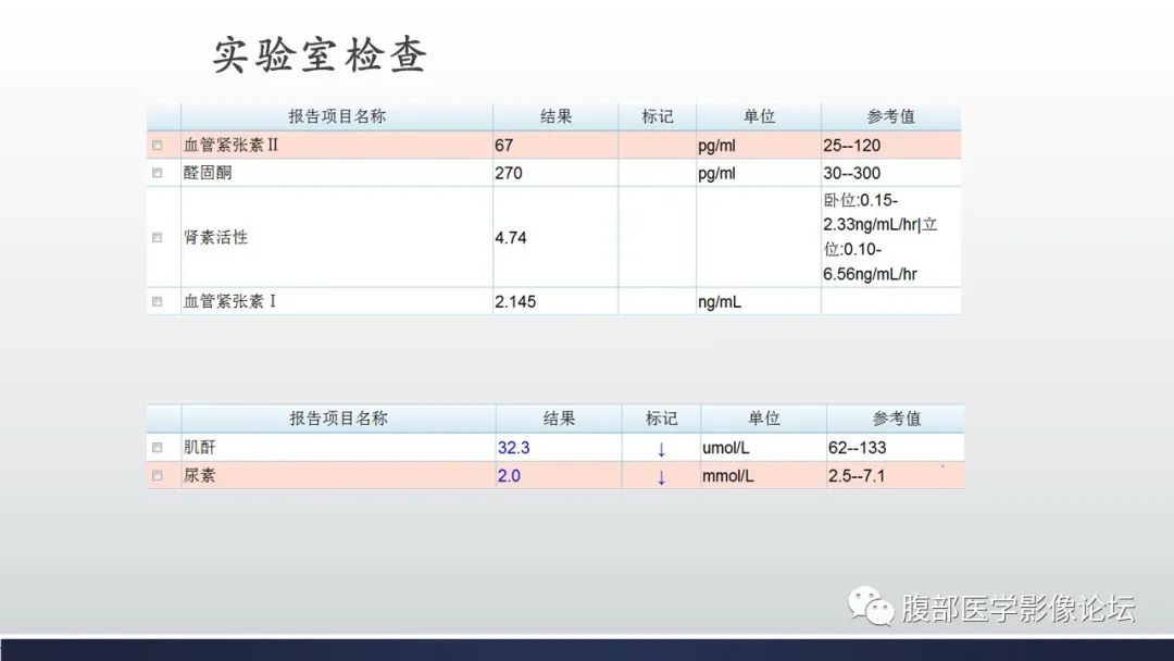 【病例】肾上腺平滑肌瘤伴钙化1例CT影像