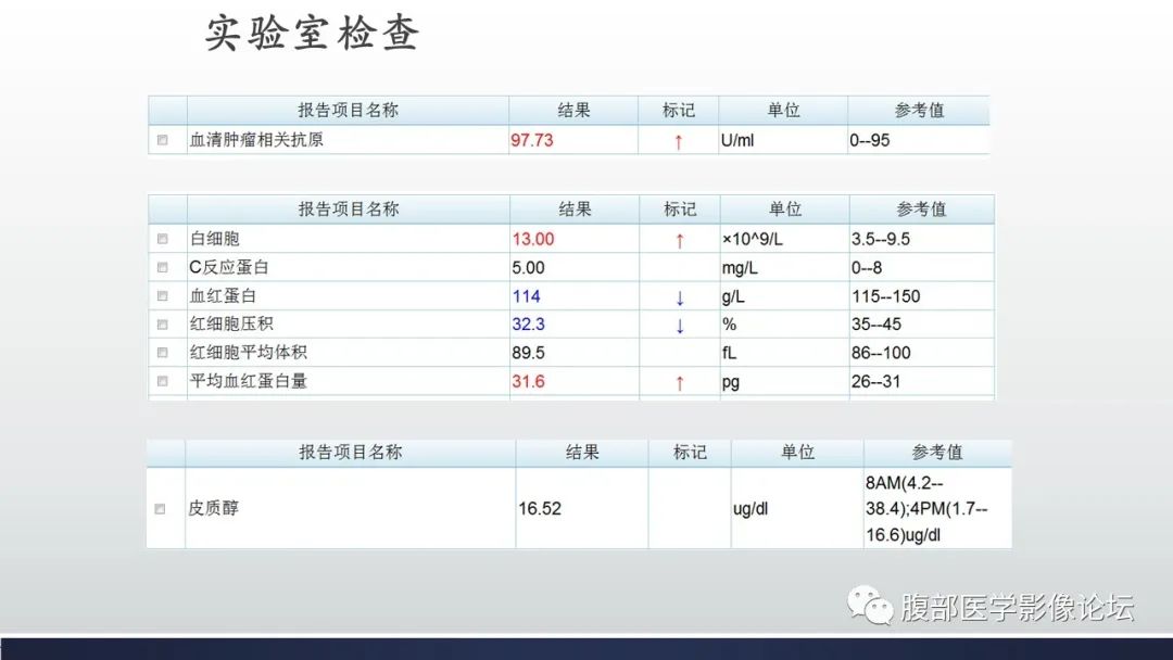 【病例】肾上腺平滑肌瘤伴钙化1例CT影像