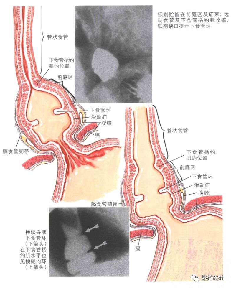 食管Schatzki环
