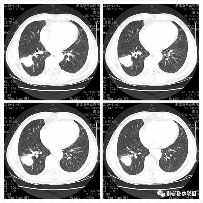 【病例】诡异的尿路肺转移瘤1例CT影像