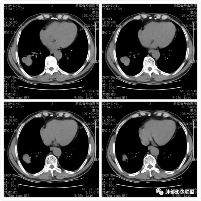 【病例】诡异的尿路肺转移瘤1例CT影像