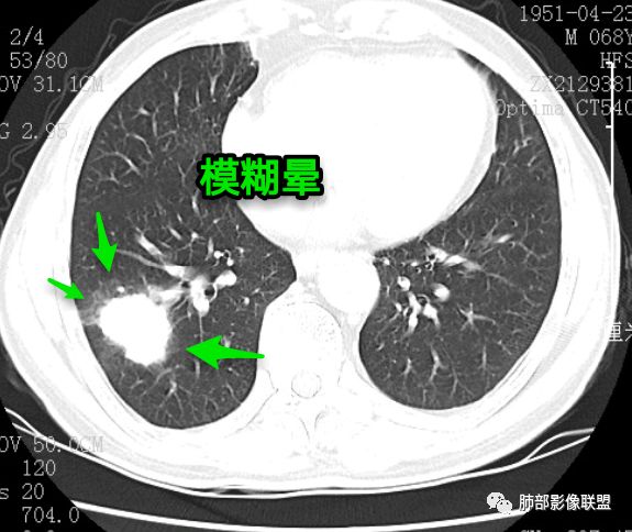 【病例】诡异的尿路肺转移瘤1例CT影像