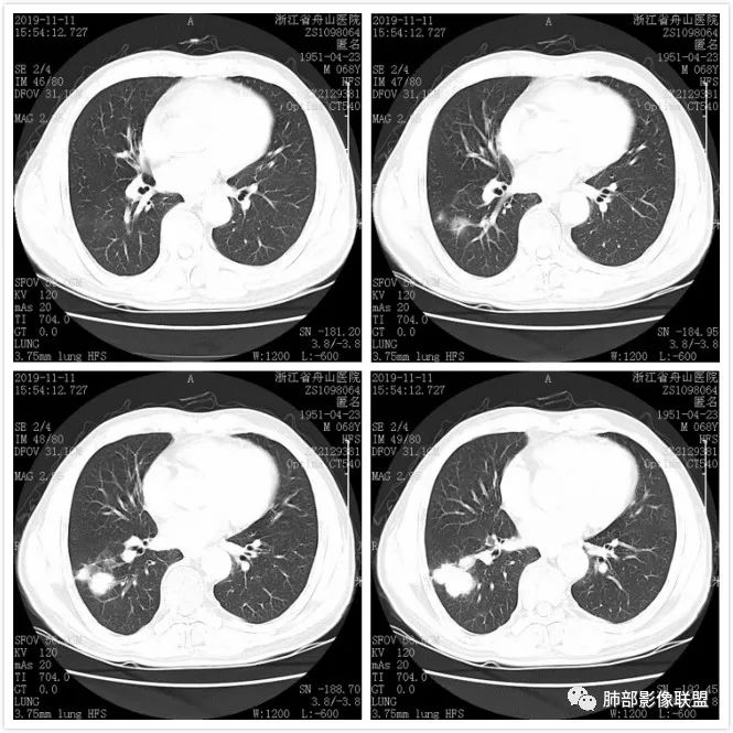 【病例】诡异的尿路肺转移瘤1例CT影像