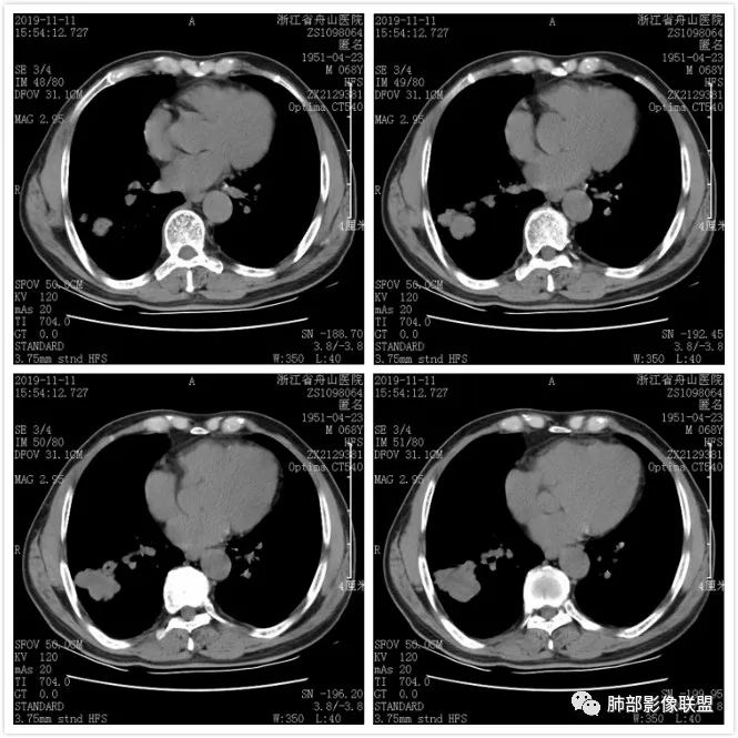【病例】诡异的尿路肺转移瘤1例CT影像