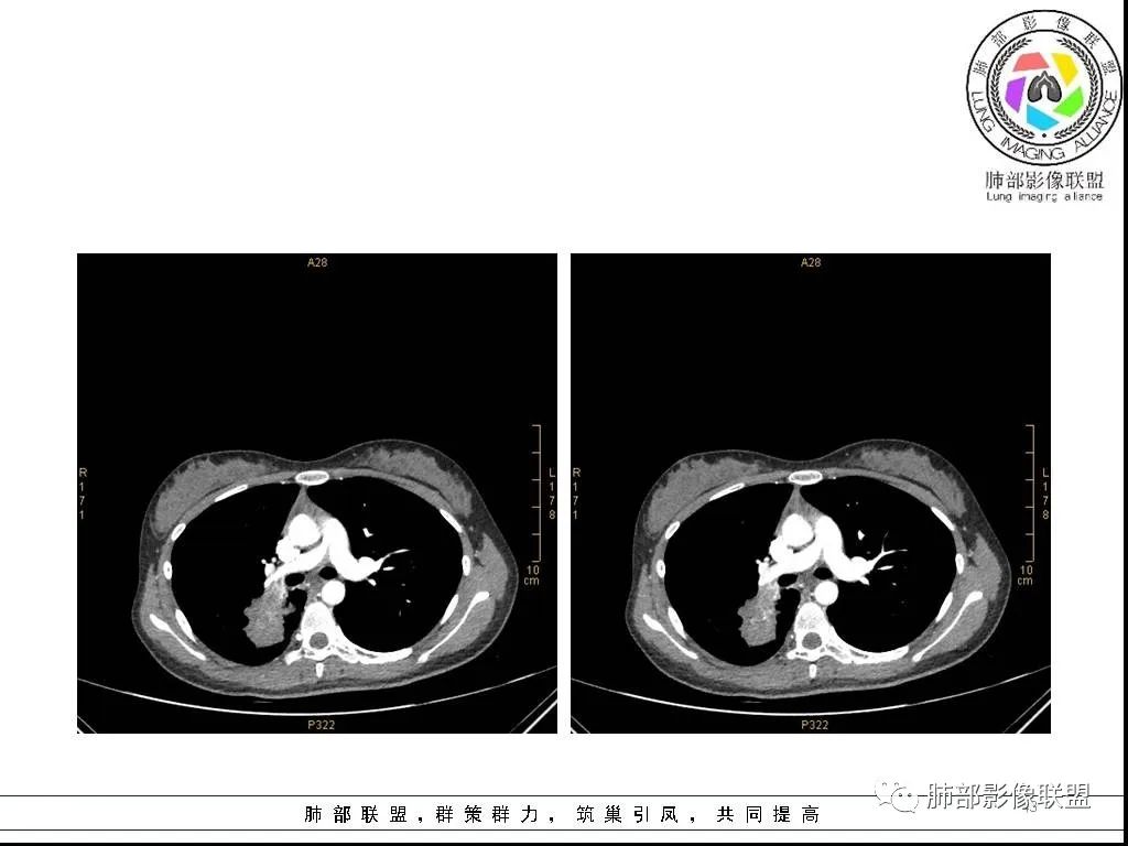 【病例】右肺炎症性病变1例CT影像讨论