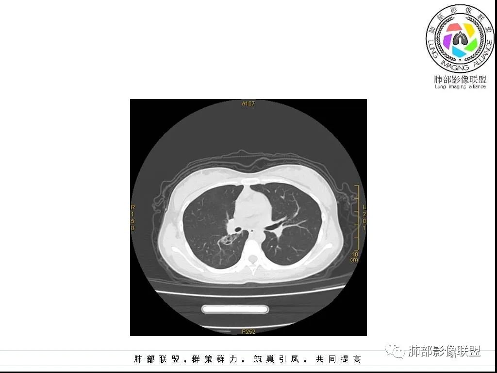 【病例】右肺炎症性病变1例CT影像讨论
