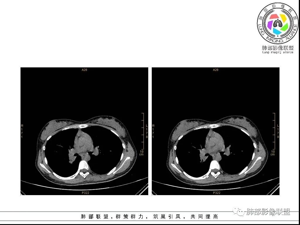 【病例】右肺炎症性病变1例CT影像讨论