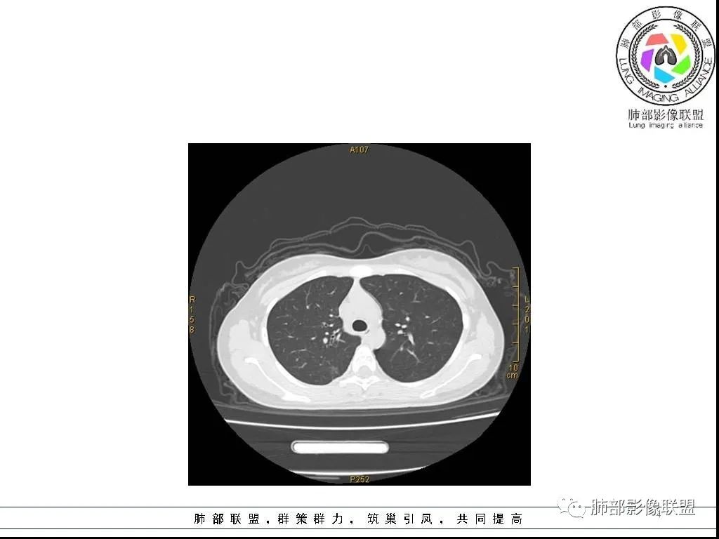 【病例】右肺炎症性病变1例CT影像讨论