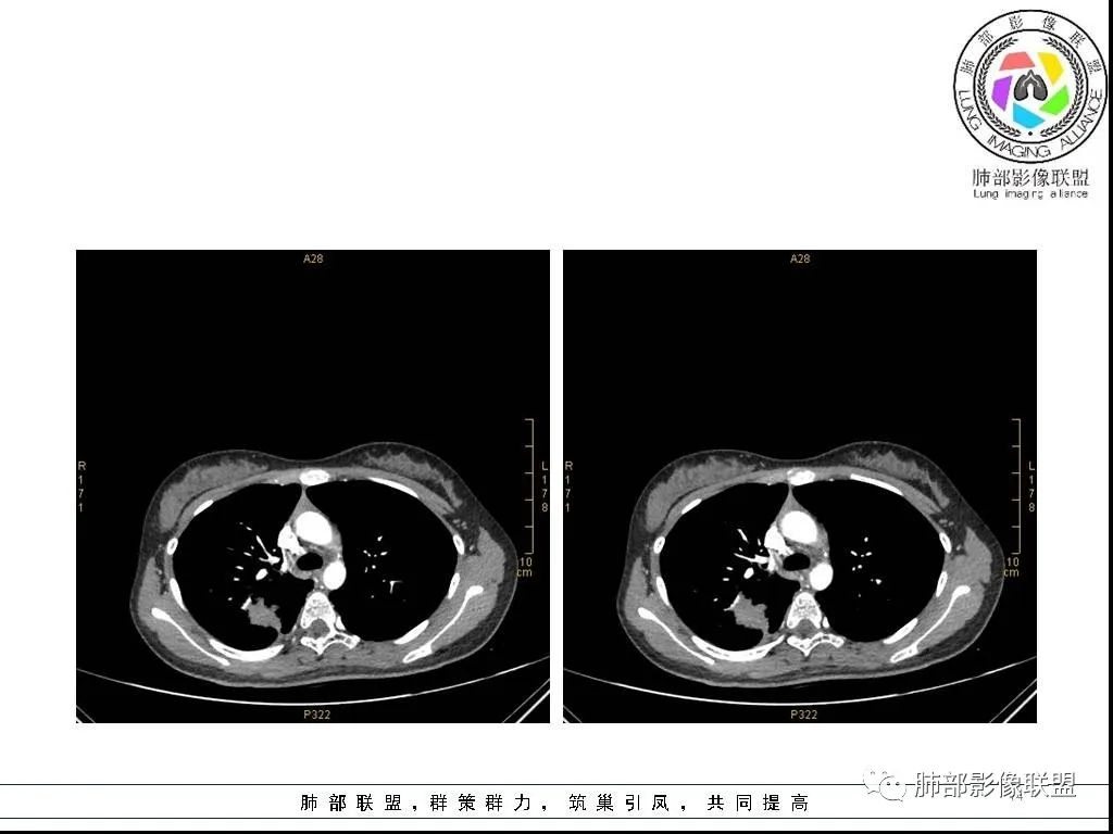【病例】右肺炎症性病变1例CT影像讨论