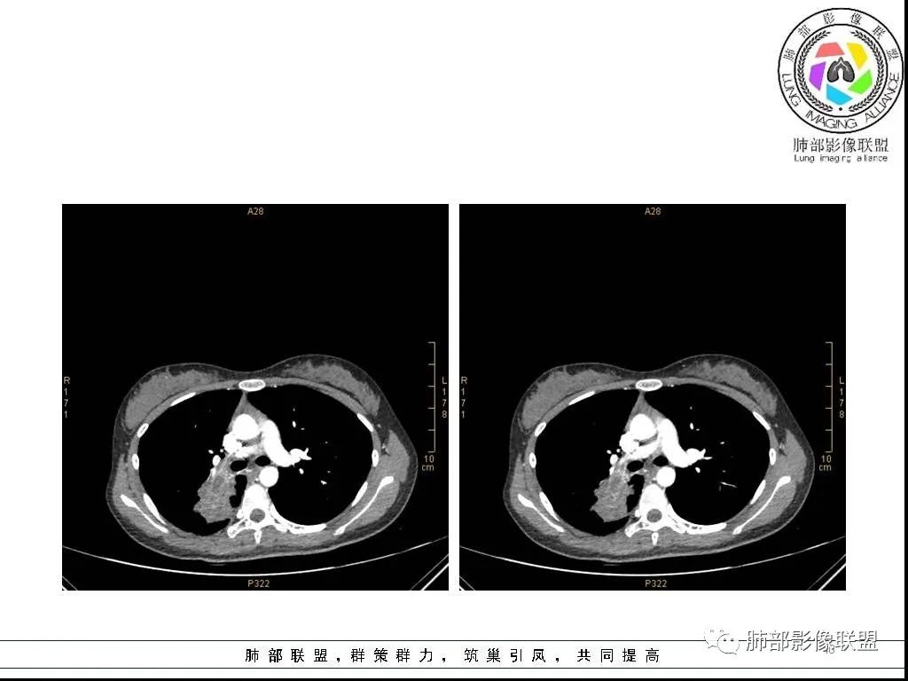 【病例】右肺炎症性病变1例CT影像讨论