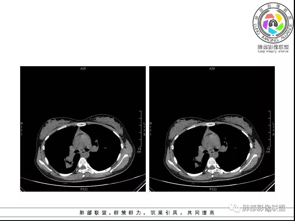 【病例】右肺炎症性病变1例CT影像讨论