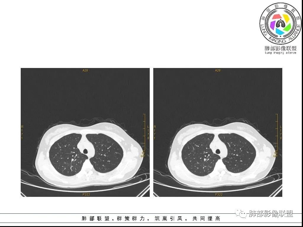 【病例】右肺炎症性病变1例CT影像讨论