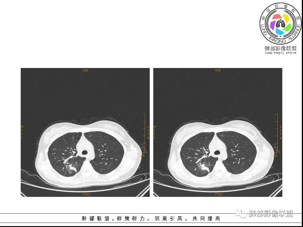 【病例】右肺炎症性病变1例CT影像讨论