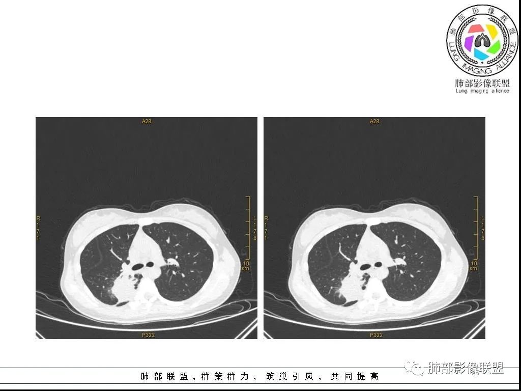 【病例】右肺炎症性病变1例CT影像讨论