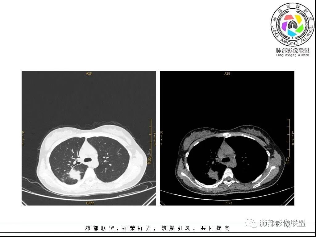 【病例】右肺炎症性病变1例CT影像讨论