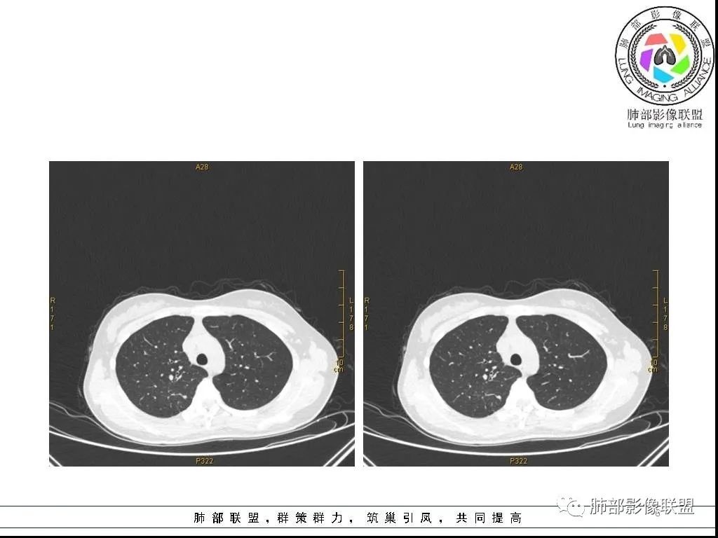 【病例】右肺炎症性病变1例CT影像讨论