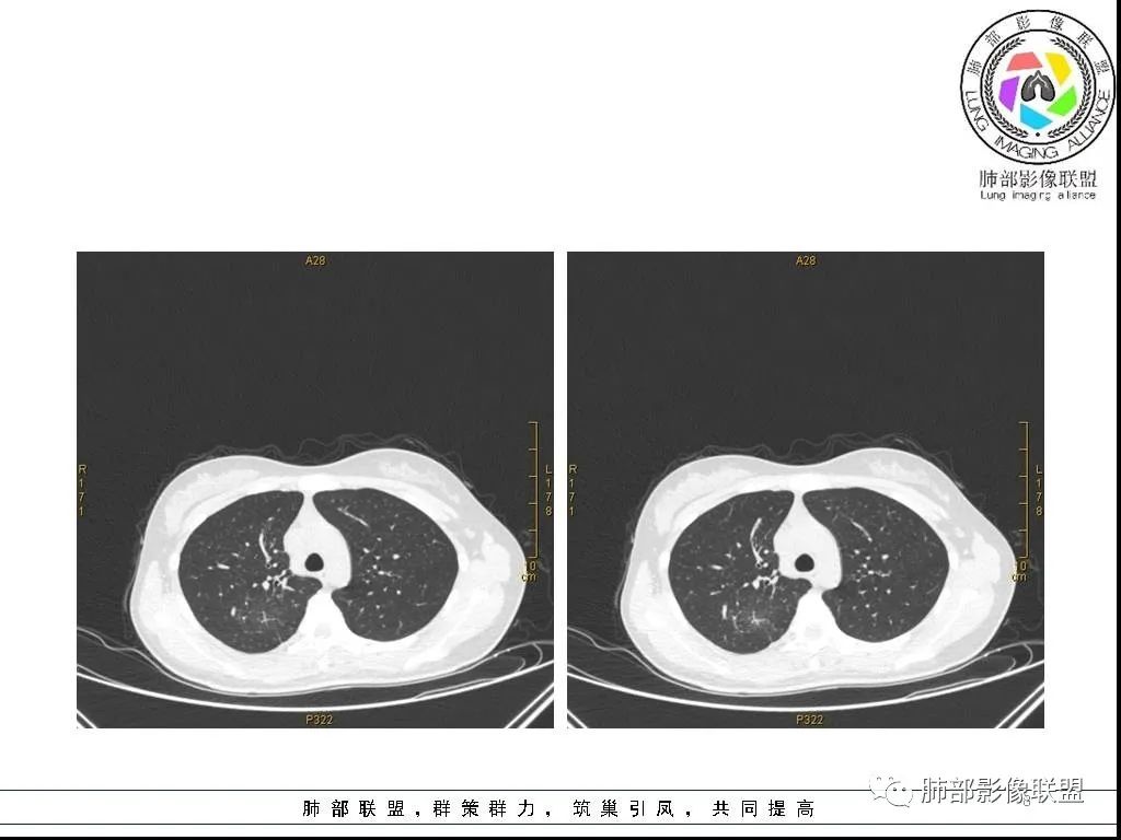 【病例】右肺炎症性病变1例CT影像讨论