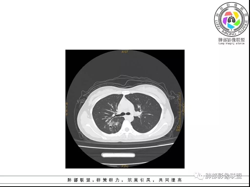 【病例】右肺炎症性病变1例CT影像讨论