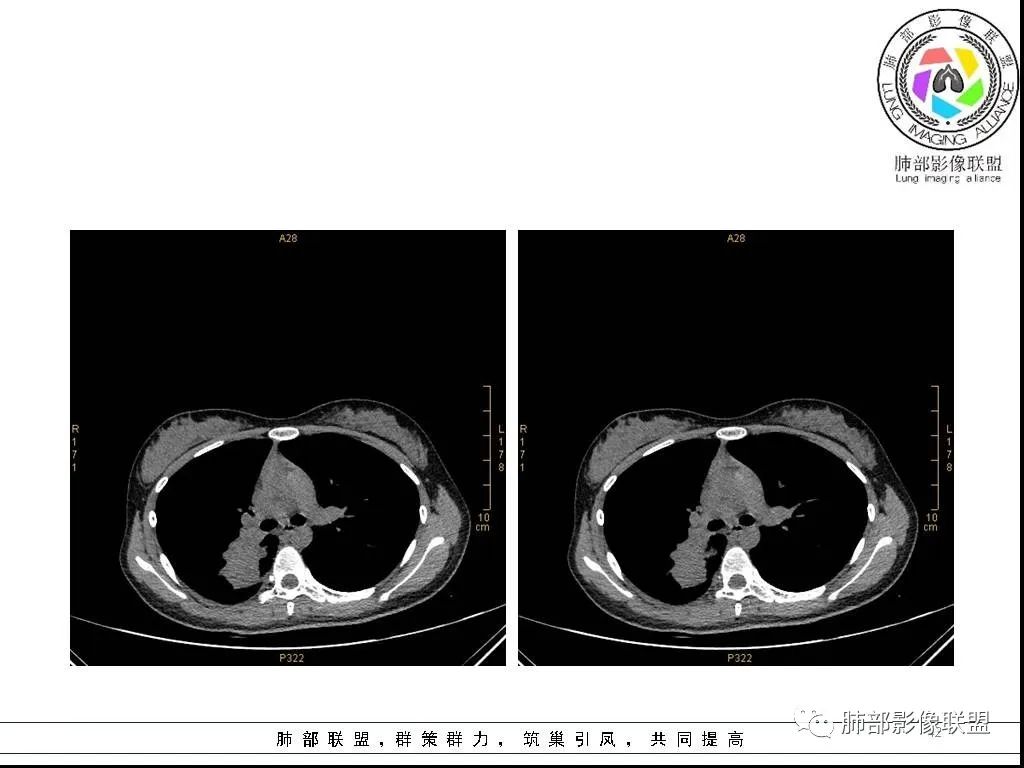 【病例】右肺炎症性病变1例CT影像讨论