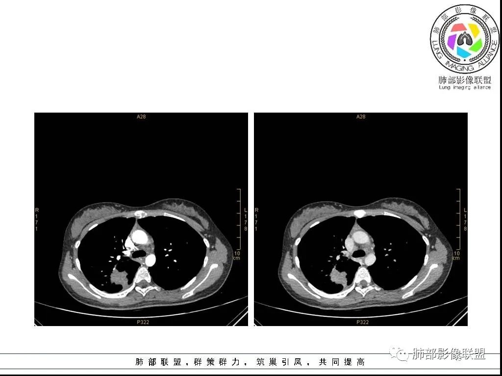 【病例】右肺炎症性病变1例CT影像讨论