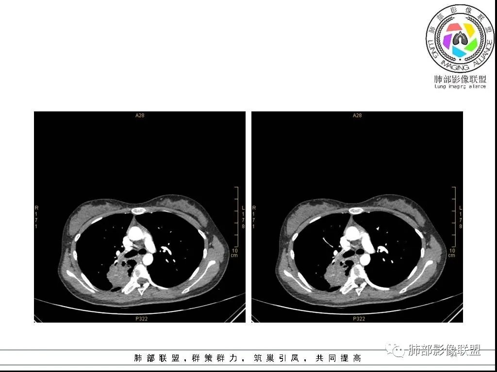 【病例】右肺炎症性病变1例CT影像讨论
