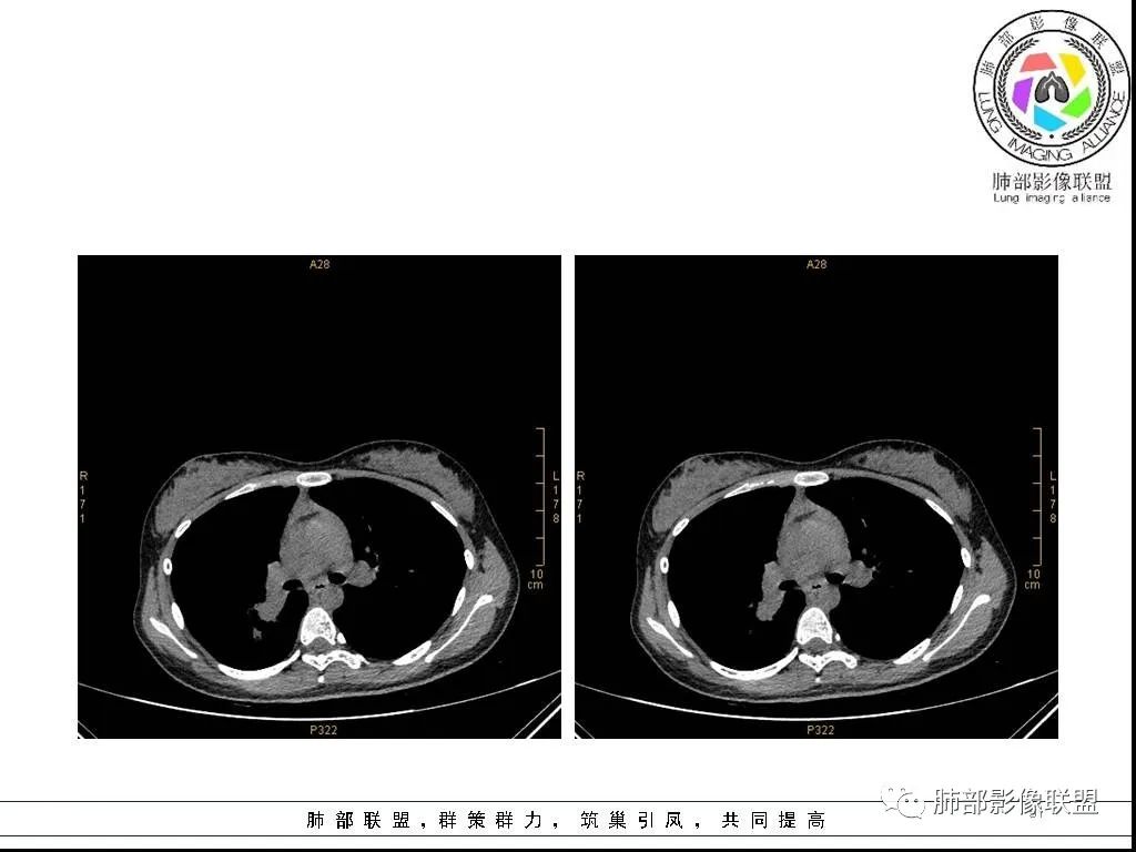 【病例】右肺炎症性病变1例CT影像讨论