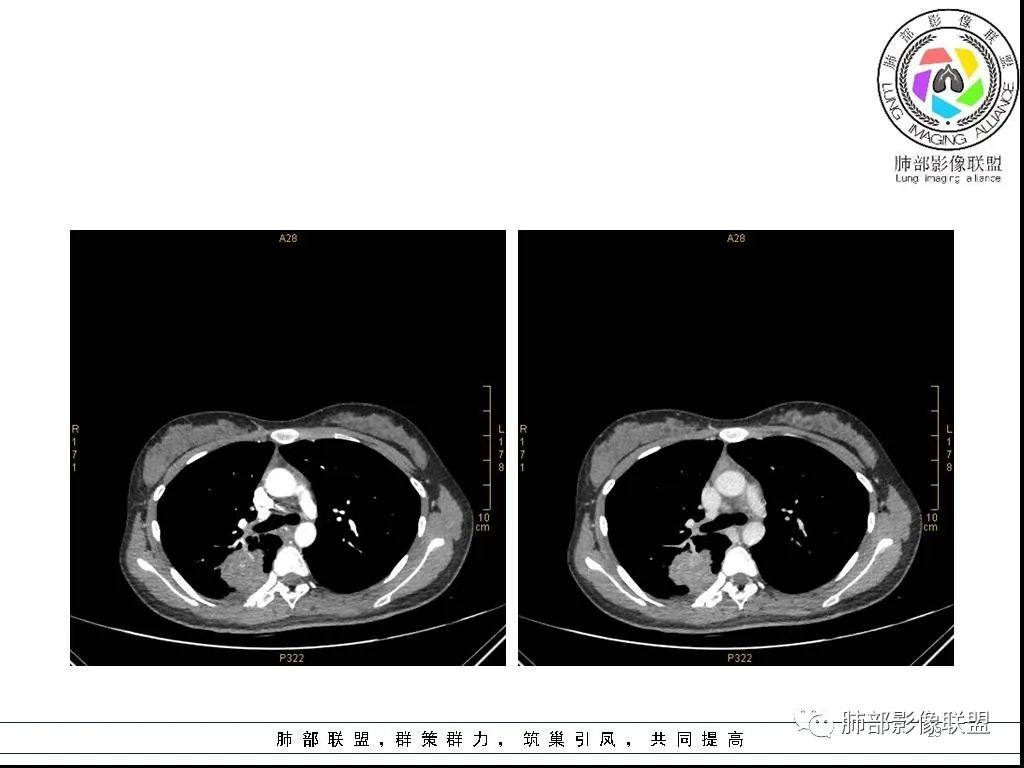 【病例】右肺炎症性病变1例CT影像讨论