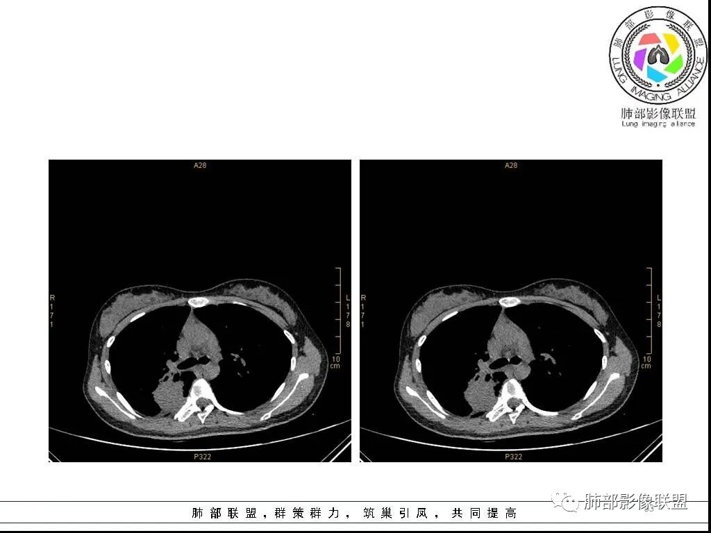 【病例】右肺炎症性病变1例CT影像讨论