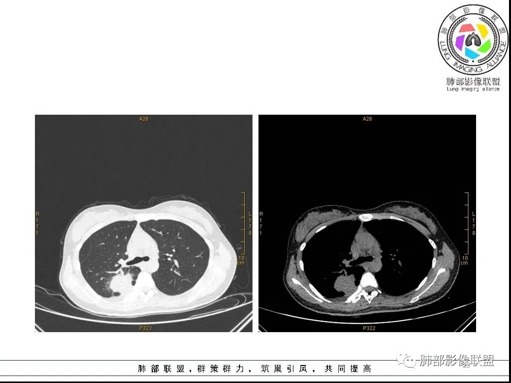 【病例】右肺炎症性病变1例CT影像讨论