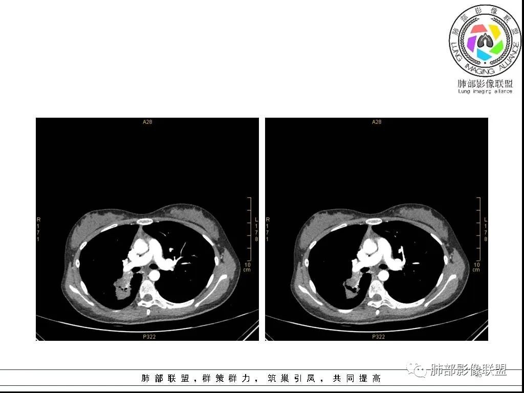 【病例】右肺炎症性病变1例CT影像讨论