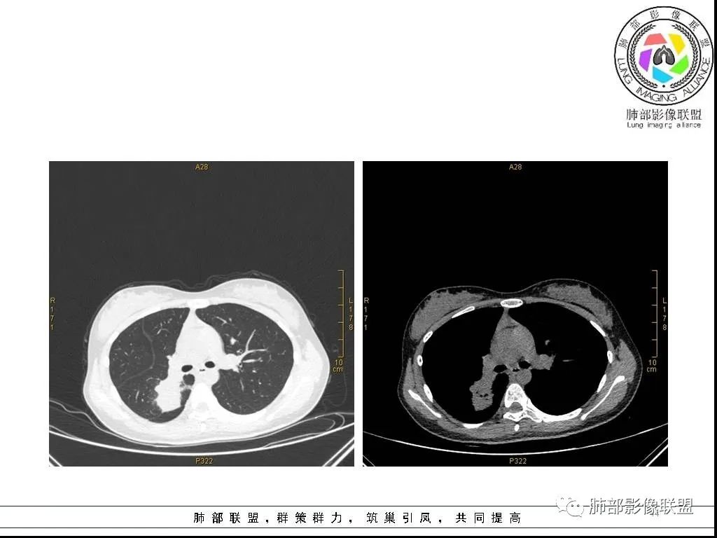 【病例】右肺炎症性病变1例CT影像讨论