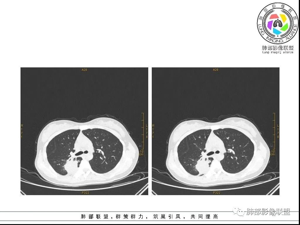 【病例】右肺炎症性病变1例CT影像讨论
