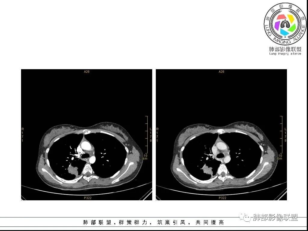 【病例】右肺炎症性病变1例CT影像讨论