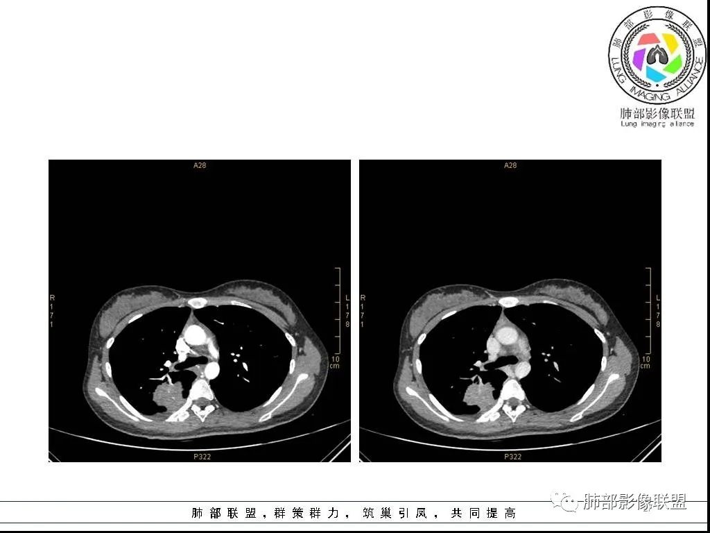 【病例】右肺炎症性病变1例CT影像讨论