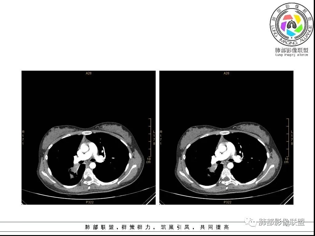 【病例】右肺炎症性病变1例CT影像讨论