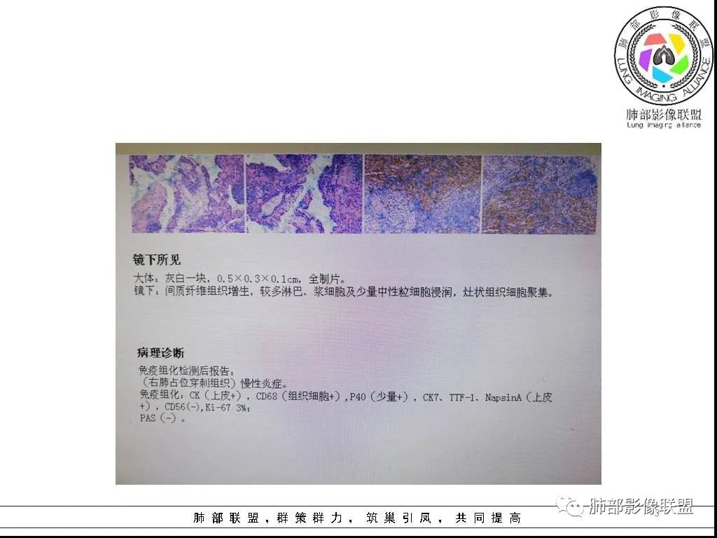 【病例】右肺炎症性病变1例CT影像讨论