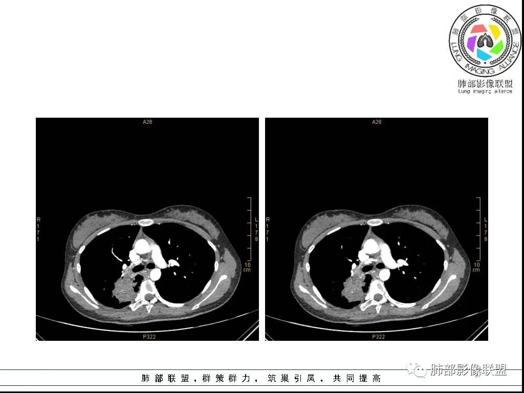 【病例】右肺炎症性病变1例CT影像讨论