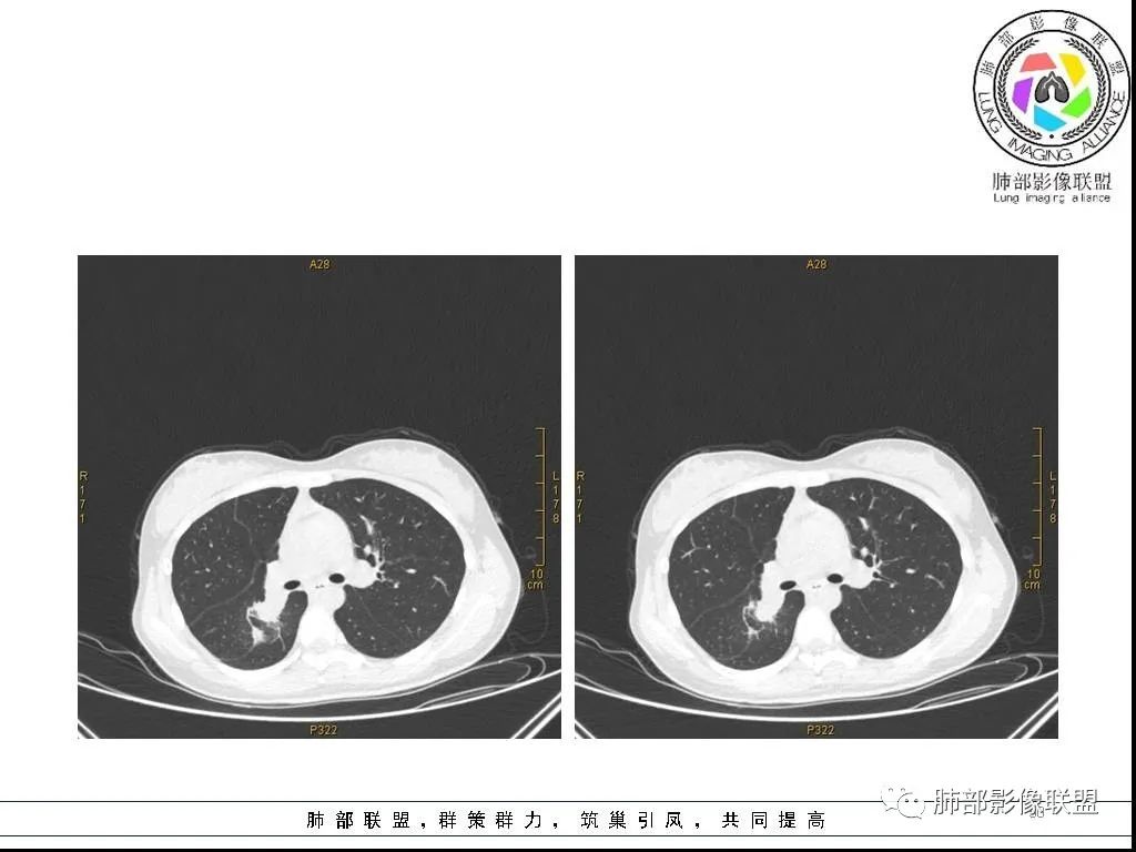 【病例】右肺炎症性病变1例CT影像讨论