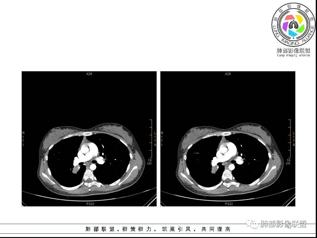 【病例】右肺炎症性病变1例CT影像讨论
