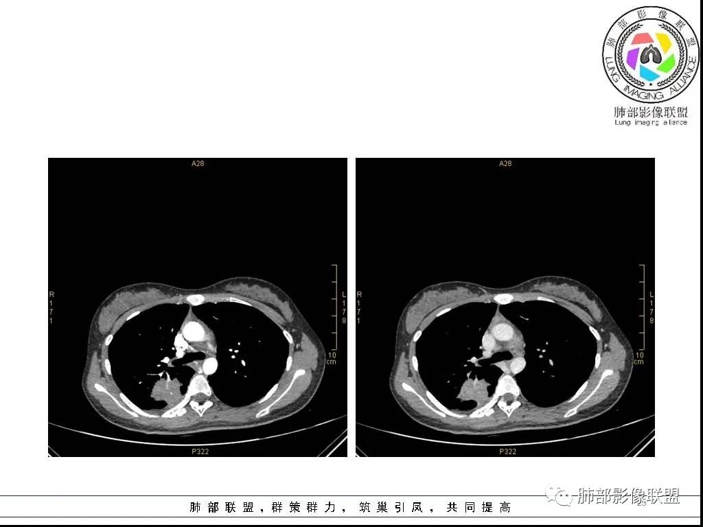 【病例】右肺炎症性病变1例CT影像讨论