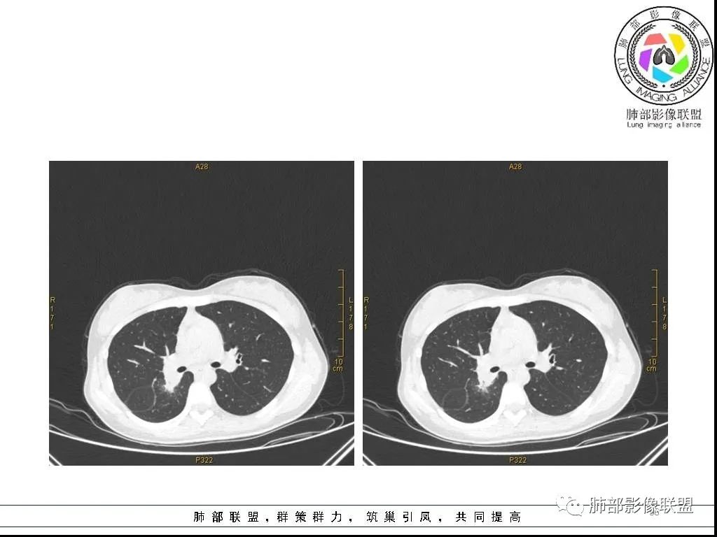 【病例】右肺炎症性病变1例CT影像讨论