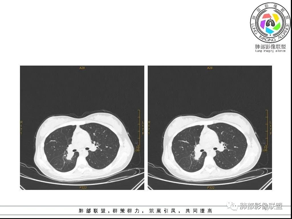 【病例】右肺炎症性病变1例CT影像讨论