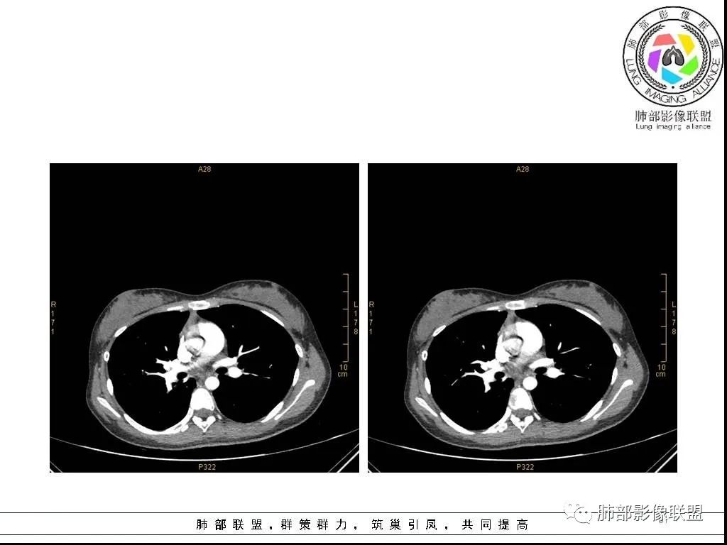【病例】右肺炎症性病变1例CT影像讨论