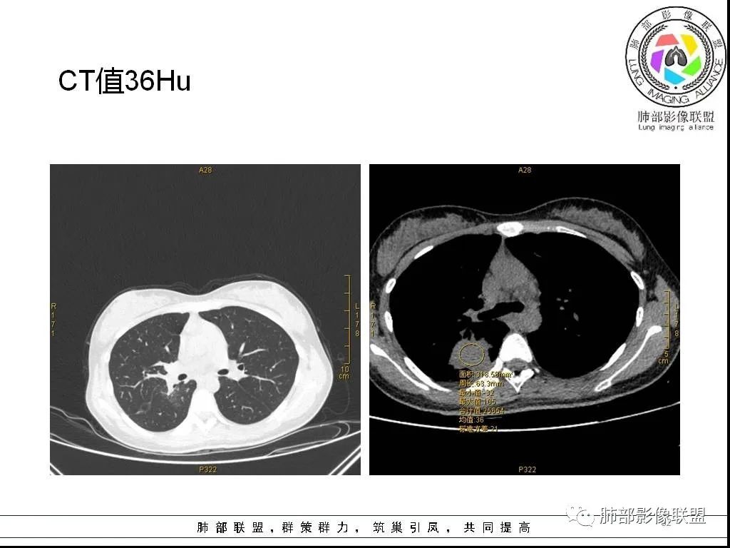 【病例】右肺炎症性病变1例CT影像讨论