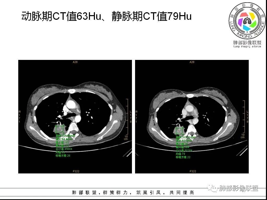 【病例】右肺炎症性病变1例CT影像讨论