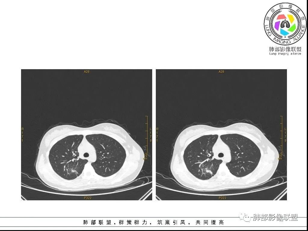 【病例】右肺炎症性病变1例CT影像讨论