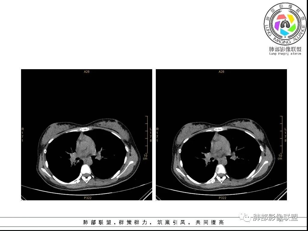 【病例】右肺炎症性病变1例CT影像讨论