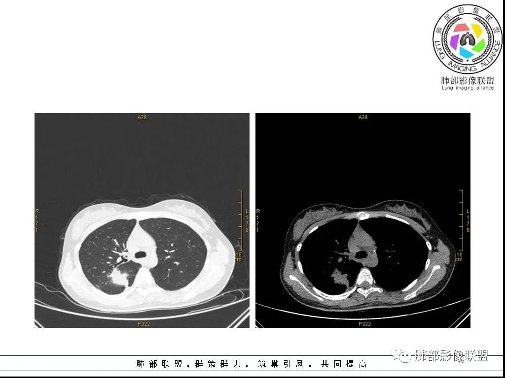 【病例】右肺炎症性病变1例CT影像讨论