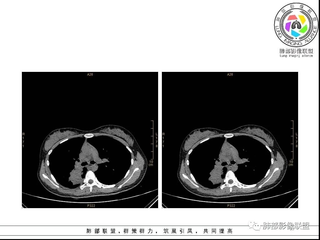【病例】右肺炎症性病变1例CT影像讨论